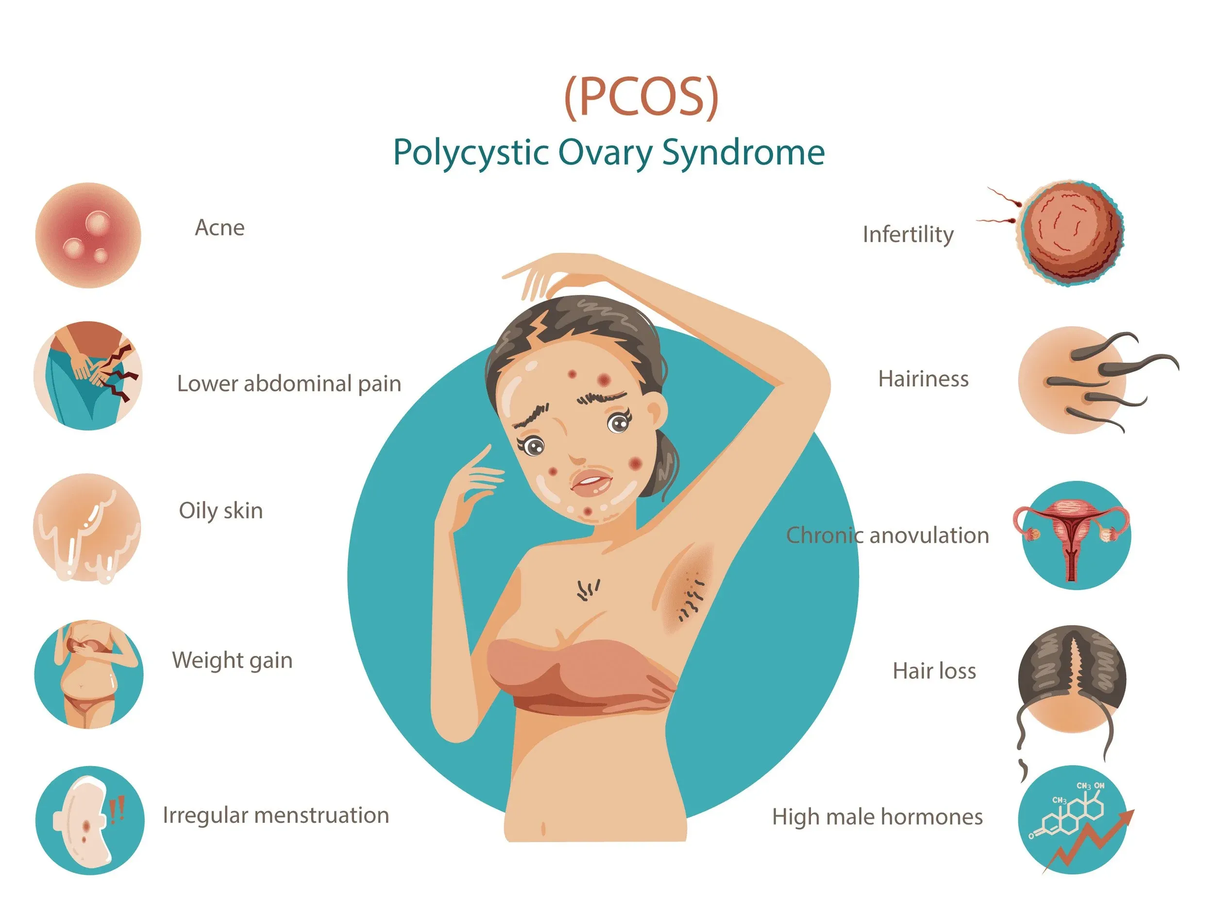 Pattanás és PCOS kapcsolata